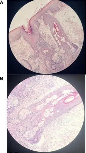 Figure 2 The scalp biopsy showing marked neutrophilic infiltrate of the hair follicles and deep dermis at low (A) and high (B) maginification.