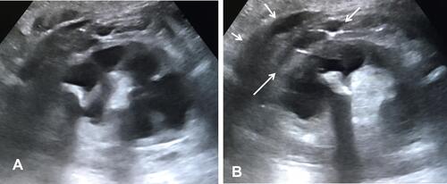 Figure 3 (A) Ultrasound of the kidney showing an “ultrasound bear-paw” with a central calculus and infiltrated fat and dilated, infiltrated calyces peripherally. The overlying cortex is chronically thinned. (B) Further ultrasound image in the same patient showing more marked calculous shadowing and a multilocular extrarenal collection (arrows).