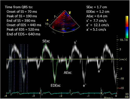 Figure 1. An example of pulsed wave tissue Doppler signals from the septal border of the mitral annulus in a healthy young adult subject showing systolic and diastolic time intervals from the onset of the Q wave on the electrocardiogram and velocity time integrals and peak velocities of the systolic, early diastolic and atrial contraction signals. SS: pulsed wave tissue Doppler imaging systolic signal; EDS: pulsed wave tissue Doppler imaging early diastolic signal; SExc: mitral annular systolic excursion; EDExc: mitral annular early diastolic excursion; AExc: mitral annular excursion during atrial contraction; s′: peak velocity of systolic mitral annular motion; e′: peak velocity of early diastolic mitral annular motion; a': peak velocity of mitral annular motion during atrial contraction