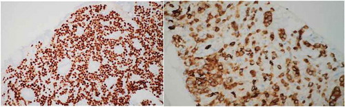 Figure 4. Left: stomach lesion biopsy staining for GATA3. Right: pancreatic lesion biopsy staining for E-Cadherin.