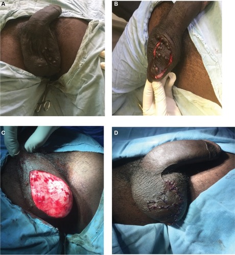 Figure 1 Patient 1: preoperative (A), intraoperative (B and C), and postoperative (D) views of idiopathic scrotal calcinosis.