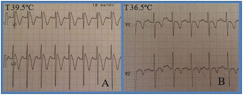 Figure 4. Fever-induced Brugada Pattern: Temperature Matters. The ECG performed with fever, 39.5°C (A), revealed a normal sinus rhythm but with a type 1 Brugada pattern (right bundle branch block-like morphology, cove-shaped ST elevation in right precordial leads > 2mm, followed by a negative T wave), which disappeared after the fever subsided with antipyretic drugs (B).