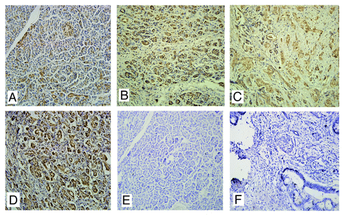 Figure 1. The expression of Ran in pancreatic cancer tissues. (A) Normal pancreatic tissues; (B) Well-differentiated; (C) Poorly-differentiated; (D) Metastatic site in the lymph node; (E and F) Negative controls of normal tissues and pancreatic cancer tissues using PBS instead of primary antibody.