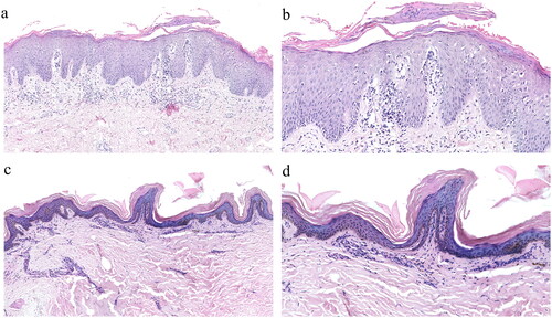 Figure 5. Histopathologic changes in skin lesions from before to after treatment (hematoxylin–eosin staining). (a, b) Before treatment, ×10, ×20. (c, d) Six months after starting treatment, ×10, ×20.
