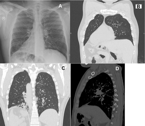 Figure 1 (A) Chest X-ray posteroanterior (PA) view and (B) computed tomography of the chest shows dextrocardia and situs inversus. (C and D) High-resolution computed tomography shows cylindrical bronchiectasis in both lungs.