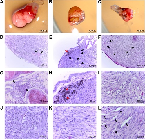 Figure 6 Glioblastoma multiforme tumor cultured on chorioallantoic membrane. (A, D, G, J) control group; (B, E, H, K) graphene oxide-treated group; and (C, F, I, L) reduced graphene oxide-treated group.Notes: Scale bar: A, B, and C, 2,000 μm; D, E, and F, 200 μm; G, H, I, J, K, and L, 100 μm. Black arrows point to blood vessels, red arrows point to graphene agglomerates.