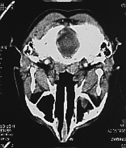 Figure 1.  Nasopharyngeal tomography of case 4 during diagnosis.