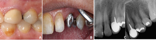 Figure 1 Preoperative intraoral view (A), after removal of crown (B), and periapical X-rays (C) of tooth # 23.