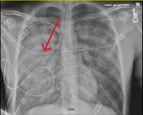 Figure 1 Chest x-ray on post-operative day 1. Red arrow pointing to consolidation in right lung.