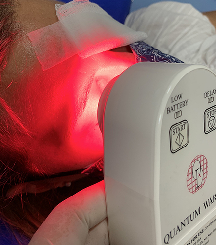 Figure 2 Quantum Devices WARP 10 is a high intensity, hand-held, portable, light-emitting diode (LED) device prototype used in our clinical study.