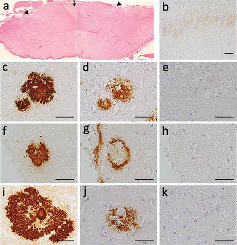Figure 2. Neuropathological data in this patient. (a) Degeneration of the posterior horn (arrow head) and fasciculus gracilis (arrow) were observed in spinal cord. (b) Synaptic prion protein (PrP) depositions are detected in posterior horn. Immunostaining with antibodies against PrP (c, f, i), Aβ42 (d, g, j), Aβ40 (e, h, k) was performed in the same location in serial brain sections. We detected three types of PrP-amyloyd β (Aβ) colocalized plaques; (c–e) overlapped type, (f–h) surrounded type, and (i–k) a unique deposition type, wherein Aβ42 deposits were sandwiched by PrP deposits. Aβ42 deposition was observed in all types (d, g, j), but Aβ40 was barely detected (e, h, k). Scale bar = 20μm.