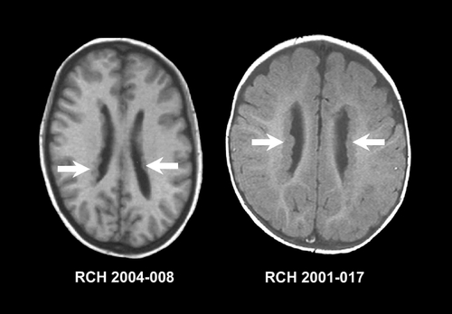 Figure 7. Imaging features of periventricular nodular heterotopia. Axial T1 weighted MRI showing too patients with bilateral periventricular nodular heterotopia, manifest by nodules of tissue with identical signal to cortical gray matter located in the periventricular region (arrows). The image on the left shows scattered nodules separated by normal white matter, whereas the image on the right shows contiguous nodules completely lining the lateral ventricle. MRI, magnetic resonance imaging