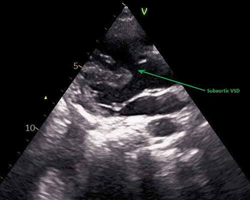 Figure 2 Echocardiography showing large subaortic VSD.