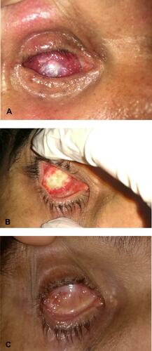 Figure 5 (A) Postoperative view of a patient in the electrocoagulation group at the end of the surgery. (B) Dermal ulceration noticed 8 weeks postoperatively. (C) Complete spontaneous healing after 32 weeks.
