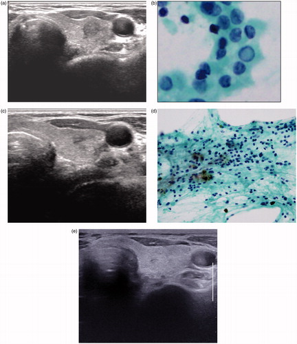 Figure 3. (A–E) Gradual reduction and complete disappearance of papillary thyroid carcinoma after radiofrequency ablation. (A) Ultrasonography of a 76-year-old woman revealed a 6-mm mass in the left thyroid gland. (B) FNA cytology of the mass revealed papillary thyroid carcinoma cells with nuclear atypia, including nuclear grooves, high N/C ratio and nuclear pseudoinclusion (Papanicolaou stain, original magnification ×400). (C) At 2-year follow-up after radiofrequency ablation, US revealed a smaller but persistent, 4-mm ill-defined ablation zone in the left thyroid gland. (D) FNA cytology of the ablation zone demonstrated benign follicular epithelial cells with hemosiderin pigment-laden macrophages (× 100). (E) At 4-year follow-up, US revealed complete disappearance of the ablation zone.