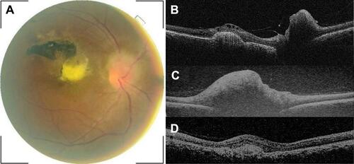 Figure 1 Baseline right eye fundus fundus photo of patient #1 showing papilledema in the superior part of optic disc and chorioretinal scar and fibrosis near the macula (A). Baseline OCT (B) shows optic disc elevation, pigment epithelium detachment with a few pockets of intraretinal liquid and subretinal fibrotic tissue in the macula area. After treatment, there was no apparent change on fundus photograph whereas OCT scans shows persistence of the disc elevation (C) and resorption of the intraretinal liquid (D).