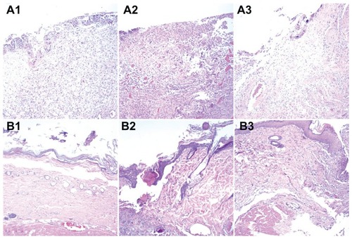 Figure 9 Histological images of (A) PLGA/collagen group and (B) PLGA/collagen with vancomycin, gentamicin, and lidocaine group at weeks 1, 2, and 3. (No necrosis was observed in B3).Abbreviation: PLGA, poly(D, L)-lactide-co-glycolide.