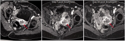 Figure 5. Axial T1W images with fat suppression pulse and after contrast enhancement with gadolinium chelate before and after treatment of an intra-pelvic tumor. The pretreatment image shows the non-enhancing tumor mass at the vaginal vault on the left (red arrow). There is no substantial change in tumor volume post treatment, either at Day 7 or Day 30, and no change in the relative enhancing and non-enhancing components (red arrows).