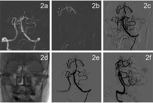 Figure 2. DSA imaging during drug-coated balloon dilatation angioplasty.(a) A 5F*115 cm Navien intermediate catheter selected to the V2 end of the left vertebral artery for fixation. (b) A 3-m Synchro microguide with Rebar18 microcatheter fed through the occluded segment followed by intracatheter angiogram showing that the catheter was located in the true lumen of the vessel. (c) Ten minutes after 2.5 × 15 mm Gateway balloon dilation, the lumen of the stenosis was retracted significantly. (d) The microguide wire was fixed in the left superior cerebellar artery, and a 2.5 × 20 mm paclitaxel drug-coated balloon was used for dilation. (e, f) After drug-coated balloon dilation, the patient was observed for 50 min and re-imaged. The patient had good lumen formation of the basilar artery, no retraction, no artery dissection, distal flow patency, and mTICI grade 3.