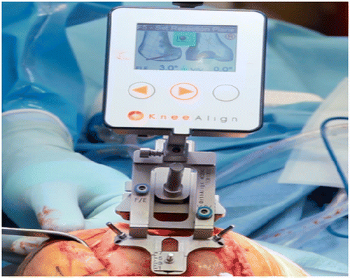 Figure 2. Intraoperative photograph of the KneeAlign 2™ device. The display console attaches to the front of the femoral jig, and provides real-time feedback on both the distal cutting block's mechanical axis varus/valgus alignment and flexion/extension alignment.
