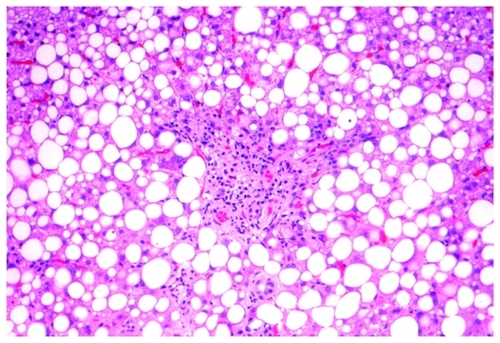 Figure 2 Macrovesicular steatosis in 80% of the biopsy volume with focal necrosis of hepatocytes and mild infiltrate of lymphocytes around necrotic lesions and on sinusoids of the liver.