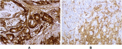 Figure 3 CD44 expression in CRC. (A): intense CD44 expression, OM 100×; (B): no CD44 expression in tumor parenchyma, compared with surrounding stromal tissue, OM 200×.