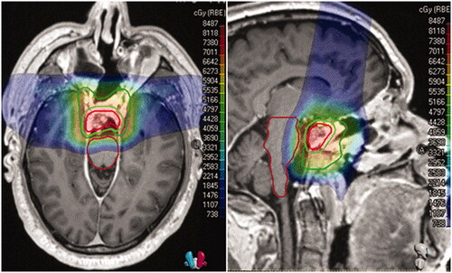 Figure 1. Colorwash dose distribution. The gross tumor volume (GTV) is in red, the planning target volume (PTV) to 50.4GyRBE is in forest green, to 73.8 GyRBE is in lime green, and the brainstem is in maroon.
