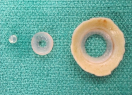 Figure 2 Double trephinated donor cornea for Boston type 1 keratoprosthesis with central 3 mm button removed.