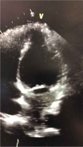 Figure 4. Echocardiogram also revealing basal ballooning in this reverse variant of Takotsubo cardiomyopathy.