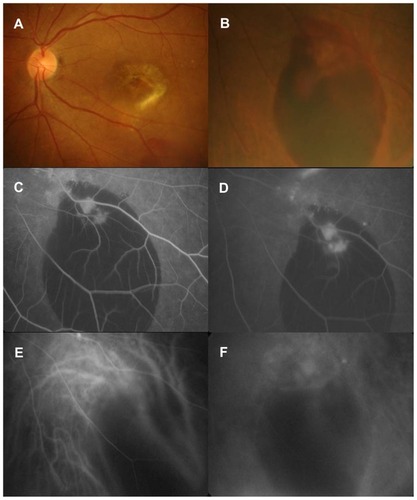 Figure 1 Fundus findings of the left eye before ranibizumab treatment. Fundus photographs (A) and (B) depict age-related macular degeneration (A) and subretinal hemorrhage (B) in temporal inferior region of macula. Fluorescein angiographic (C) and (D) and indocyanine green angiographic (E) and (F) findings reveal choroidal neovascularization corresponding (arrows) to the region of subretinal hemorrhage.
