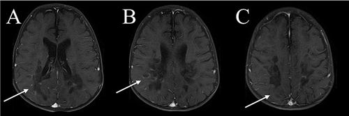 Figure 3 Postcontrast study with gadolinium-enhanced MRI of the brain; (A–C) show mild focal linear enhancement on both sides with greater enhancement on the right side (marked by white arrows).