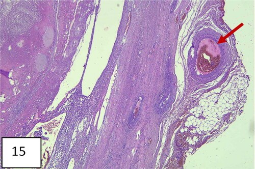 Figure 15. Histological image: chorionic villus with trophoblast invading myometrial muscle (direct contact). Hematoxylin and eosin staining; 200×.