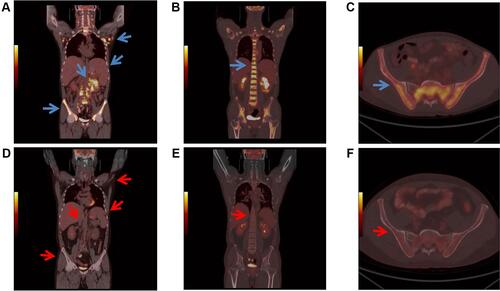 Figure 5 PET/CT finding. (A–C) Before chemotherapy. (The largest lymph nodes was in the lower abdominal mesenteric region 68mm x 42mm, SUVmax =8.2). (D–F) After three courses of chemotherapy (The spleen reduced obviously, whose metabolism was normal (SUVmax=2.6)). (A) Widespread lymph node enlargement and hypermetabolism, splenomegaly, kidney hypermetabolism (blue arrows) and diffuse bone marrow hypermetabolism. Its inferior border approached the upper margin of pelvis (SUVmax= 2.9); (B) spinal hypermetabolism (blue arrow); (SUVmax =9.0); (C) iliac hypermetabolism (blue arrows); (D) no abnormal lymph nodes were found. The volume of spleen was smaller than before, and the metabolism of bone marrow, kidney metabolism were normal (red arrows); (E) normal spine metabolism, (SUVmax =3.3) (red arrow); (F) normal ilium metabolism (red arrows).