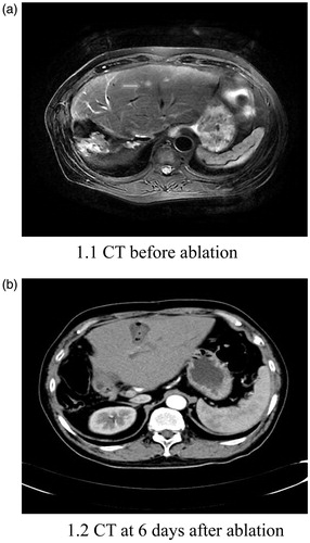 Figure 1. Abdominal CT of a 56-year-old male patient. Over 1 year after surgery for hilar hepatocellular carcinoma, this patient underwent ablation of a recurrent lesion in the left lobe of the liver. Following ablation, he developed intermittent fever and chills. An abdominal CT scan at 6 days after ablation shows the abscess in the ablation area.