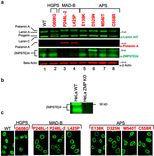 Figure 2. Analysis of prelamin A processing status and nuclear morphology in patient cells used in this study. (a) Immunoblots of protein extracts from WT and HGPS, MAD-B, and APS patient fibroblasts. Extracts from fibroblasts, prepared at passage 12 were analyzed by 10% SDS-PAGE transferred to nitrocellulose, and probed with the indicated antibodies. The panels from top to bottom show lamin A/C, prelamin A, ZMPSTE24, and β-actin staining, as indicated. As discussed in the text, ZMPSTE24 standardly migrates anomalously in SDS-PAGE at ~ 40–50 kD (unlike the calculated MW of 55 kD) as a doublet or smear. (b) Validation of α-ZMPSTE24 antibody (Invitrogen, #PA1 –16,965 lot # UD2763487) used in this study, in extracts from HeLa cells that do (WT) and do not (ZMPSTE24 KO) express ZMPSTE24. (c) Representative immunofluorescence micrographs of WT and patient cells, stained with anti-lamin A/C antibody. Scale bar is 20 µm.