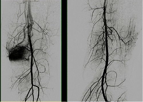Figure 5 The angiogram showed a good angiographic response, which indicated as ≥90% disappearance of tumor vascularity and tumor stain.