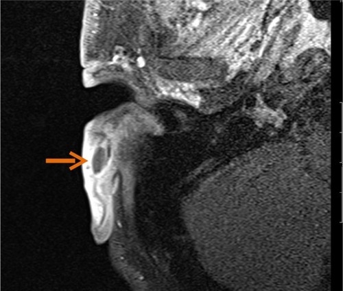 Figure 10 Contrast-enhanced magnetic resonance image of the left ear of a patient with an abscess (arrow) due to Actinomyces spp. earlobe infection following acupuncture.