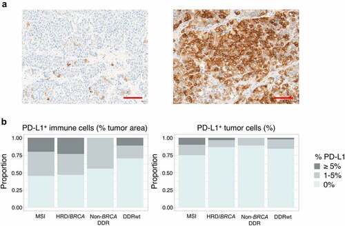Figure 4. PD-L1 expression. (a) Examples of PD-L1 stainings. The left image shows a tumor sample with PD-L1+ immune cells in 1% of tumor area and PD-L1 expression on 1% of tumor cells. The sample with the highest tumor cell expression in our cohort is depicted on the right. In this sample (only a part is shown) 30% of tumor cells expressed PD-L1 on their cell surface. The scalebar represents a length of 100 µm. (b) The proportion of patients with PD-L1 expression on immune (left) and tumor cells (right) per genomic subgroup. To avoid overrepresentation of patients with multiple samples, samples were weighted based on the number of available samples per patient (with each sample counting as 1 observation if one sample was available and each sample counting as 0.5 observation if two samples were available). No significant differences were observed between genomic subgroups.