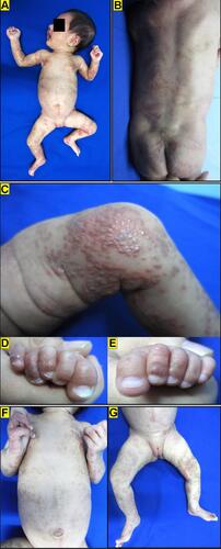 Figure 2 (A and B) Distribution of the lesions on almost all parts of the body, except the scalp, face, palm and soles, in a two-month-old girl with incontinentia pigmenti. (C) Verrucous papules left knee and (D–E) finger toes. (F–G) Hyperpigmented macules distributed linearly and swirled along Blaschko’s lines in trunks and both legs.
