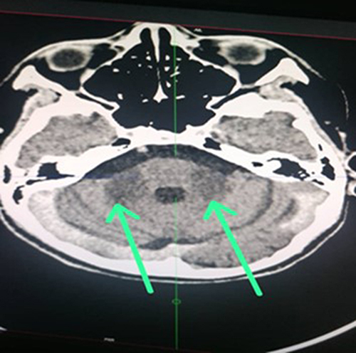 Figure 2 Bilateral and symmetrical hypodensity of the cerebellar peduncles (green arrows).