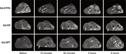 Figure 4 Magnetic resonance real-time tracking of the spread of the gene vector in vivo. Before and after injection locally, diffusion of Gd-DTPA/pRFP (Gd-DTPA), Gd-DP/pRFP (Gd-DP), and Gd-DPT/pRFP (Gd-DPT) in the tumor were monitored by T1 weighted imaging (white arrows). For Gd-DTPA, spread in tumor tissue was limited and washout was rapid; for Gd-DP, spread was limited but washout was difficult; and for Gd-DPT, the spread was homogeneous and washout was slow. The tumors are outlined with yellow dot lines on images.Abbreviations: Gd, gadolinium; pRFP, plasmid red fluorescence protein; DGL, dendrigraft poly-L-lysine; PEG, polyethylene glycol; Gd-DTPA, gadopentetate dimeglumine; DP, DTPA-DGL-PEG; DPT, DTPA-DGL-PEG-TAT.