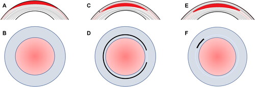 Figure 10. (A) Central profile of tissue removal (red) for a myopic surface ablation with anterior peripheral lamellae no longer in tension. (B) Top view of surface ablation without a flap or a cap. (C) Central profile of tissue ablated (red) in myopic Laser-Assisted Keratomileusis (LASIK) with a flap overlying the ablated region and peripheral lamellae without tension. Severed lamellae in anterior flap region can no longer bear tension. (D) Top view of LASIK with near circumferential severing of lamellae in flap region with the presence of a hinge, often nasal. (E) Central profile of lenticule creation for tissue removal (red) in myopic Small Incision Lenticule Extraction (SMILE) with a cap overlying the lenticule and lamelle in region of cap under reduced tension than pre-operatively due to longer arclength on posterior cap than anterior residual stromal bed. Peripheral lamellae in region of lenticule are without tension. (F) Top view of SMILE with small side cut for lenticule removal, often superotemporal.