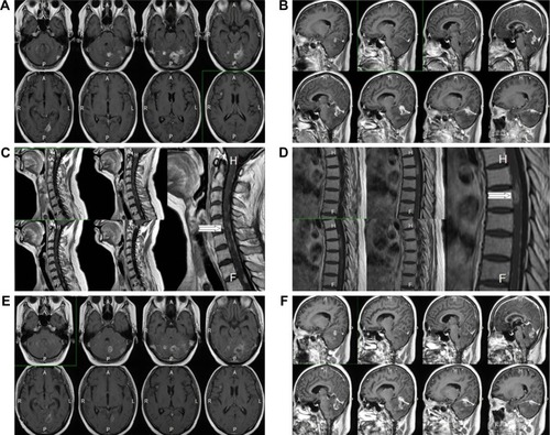 Figure 1 Brain MRI showing brain metastasis.