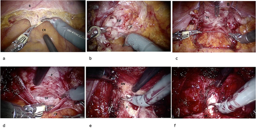 Figure 2 Steps of Retzius-sparing RARP. (a) Peritoneum incision; (b) seminal vesicles isolation; (c) sovrapubic stitches; (d) prostate posterior face isolation; (e) bladder neck incision; (f) urethra incision.
