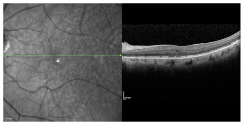 Figure 4 Postoperative optical coherence tomography (OCT) of the left eye of a 59-year-old female who had presented with a rhegmatogenous retinal detachment, which was repaired with a pars plana vitrectomy. The macula and the fovea were detached preoperatively. Preoperative visual acuity (VA) was 20/200. The external limiting membrane (ELM) and inner segment/outer segment (IS/OS) junction of the photoreceptors were disrupted. There was presence of outer retinal corrugation and cystoid macular edema. This postoperative OCT reveals persistent CME with a preserved ELM layer, but segmented IS/OS junction. The VA 1-month postoperatively was 20/60.