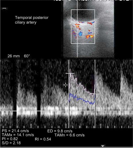 Figure 1.  Doppler spectrum of TPCA from the control group.