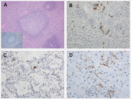 Figure 5. Pathologic analysis of selected tissues in LASV-exposed NHPs. A) Spleen, peri-arteriolar lymphoid sheath (PALS) hyperplasia in a vaccinated macaque that survived LASV challenge, 4X magnification; Inset, spleen, PALS hyperplasia with a complete absence of LASV immunoreactivity; B) Kidney, positive cytoplasmic immunoreactivity in islet and exocrine epithelial cells Of an NHP that succumbed on Day 11 post-exposure, 20x; C) Lung, cytoplasmic immunoreactivity in low numbers of alveolar macrophages, pneumocytes and endothelial cells in an NHP that succumbed on Day 17 post-exposure, 20x; D) Liver, positive apical to membranous hepatocyte and cytoplasmic endothelial immunoreactivity in an NHP that succumbed on Day 11 post-exposure, 40x.