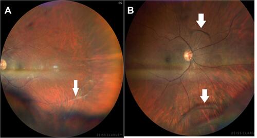 Figure 1 Color fundus in right (A) and left (B) eyes of 29‐year‐old male COVID-19 patient demonstrating (A) vascular sheathing indicating vasculitis (B) RE web like vitreous veils indicating intermediate uveitis.