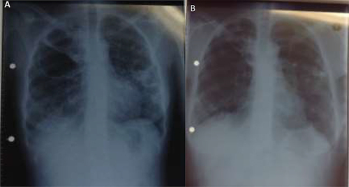 Figure 3 Plain film chest radiographs for patient three - Postero-Anterior view: (A) July 2020, showing right upper, mid-, and lower zone and left lower lobe consolidation and cavities in right upper and left lower lobes and right hilar lymphadenopathy. (B) January 2021, showing bilateral lower lobe fibrosis with fibro-cavitary changes of the right upper lobe.