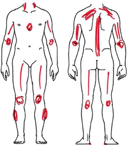 Figure 2 Pain drawing example of bilateral axial-symmetric pain distribution.